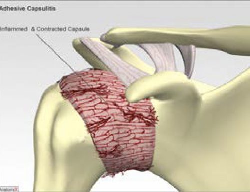 Neck and Shoulder Pain